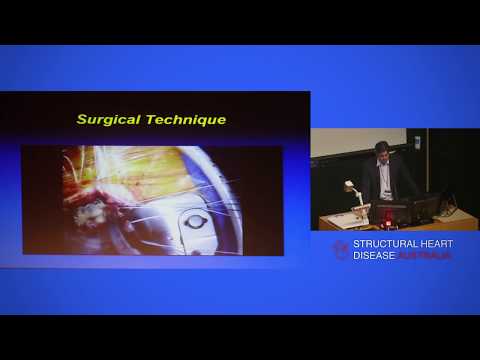 Robotic Assisted And Minimally Invasive Mitral Valve Surgery