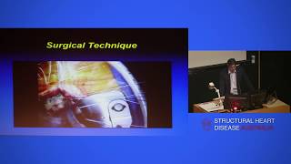 Robotic assisted and minimally invasive mitral valve surgery – Dr Paul Jansz