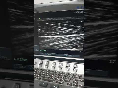 MSK Ultrasound of Muscle length and Pennation angle #ultrasound #muscle #mskultrasound #medicine