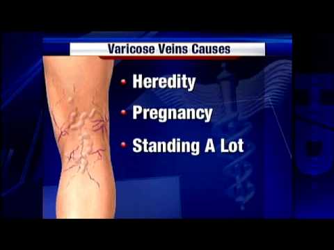Quick Fix Can Help Ease Pain Of Varicose Veins