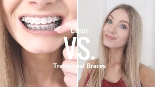 Clear VS Metal Braces | Are Clear Braces Worth It?