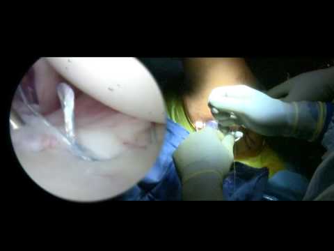 Reparación del labrum del hombro | Tratamiento de la inestabilidad del hombro