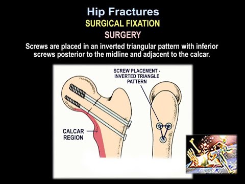 Hip Fractures Surgical Fixation - Everything You Need To Know - Dr. Nabil Ebraheim