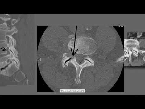 How to Read the CT Scans | How to Read CT Myelograms | How to Read Spine Imaging