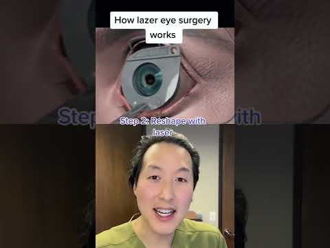 How LASIK Laser Eye Surgery Works! #shorts #lasik #lasereyesurgery
