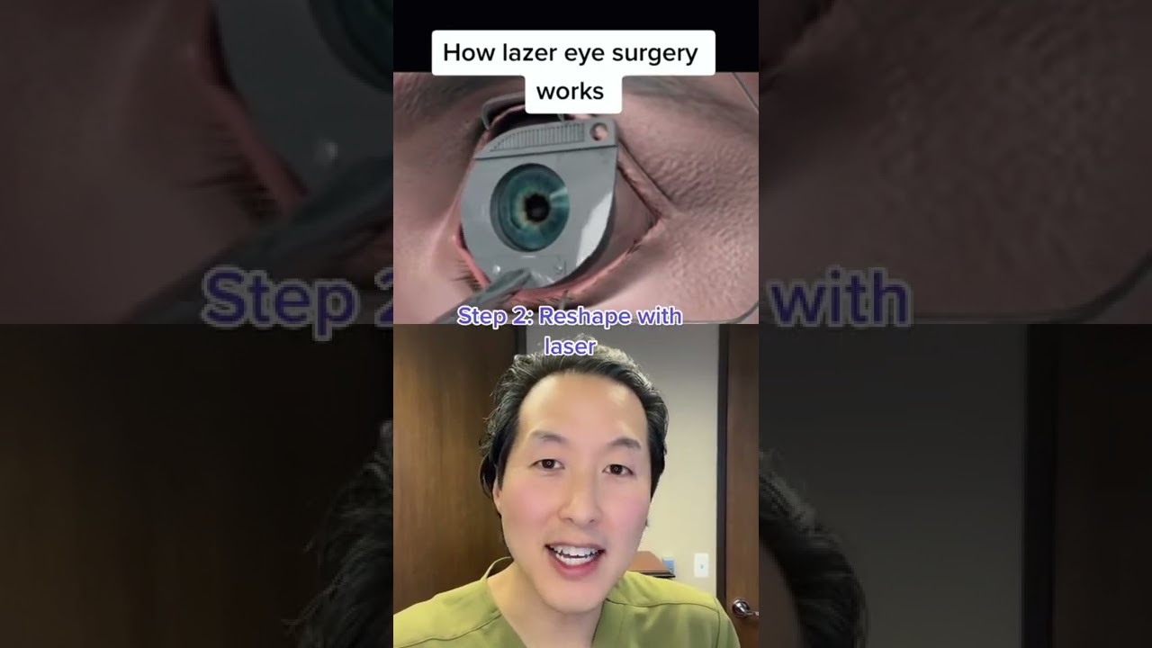 How LASIK Laser Eye Surgery Works! #shorts #lasik #lasereyesurgery