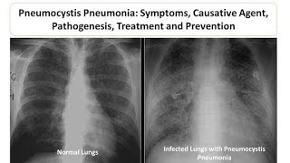 Definitive Diagnosis of Pneumocystis Pneumonia