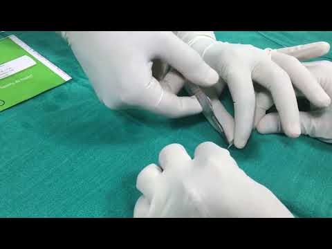 THANJAVUR SANDWITCH STENT FOR CORONARY PERFORATION AND ANURYSM