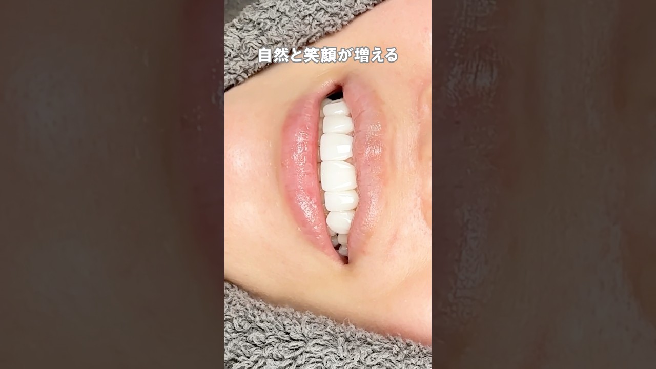 笑顔を最大限に引き出す治療"ZERORAMI"お気軽にご相談ください☺️✨ #審美歯科 #おすすめ