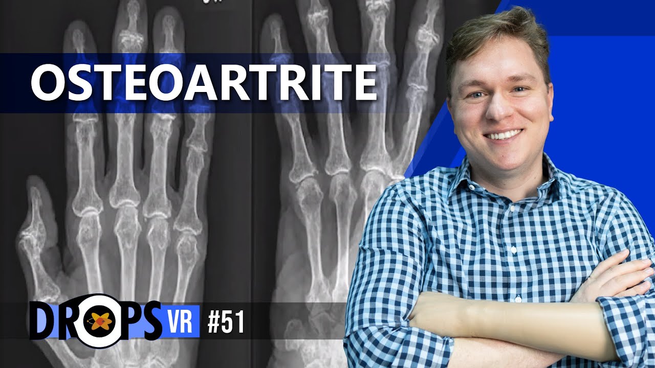 COMO IDENTIFICAR OSTEOARTROSE NO RX?