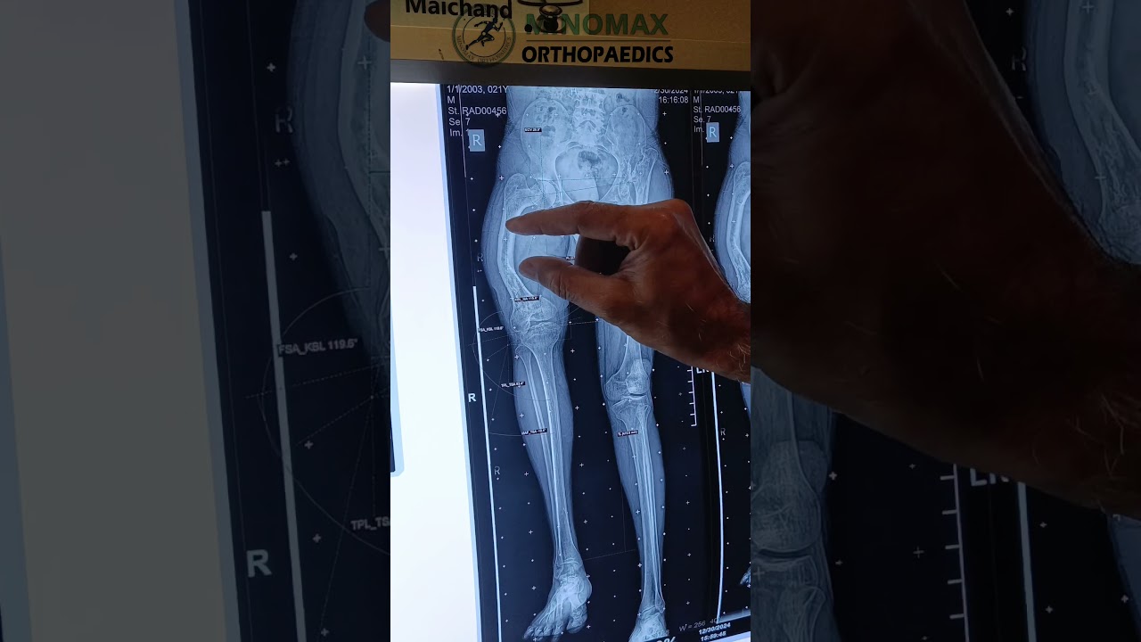 Correction plan for 7 inch Short Leg