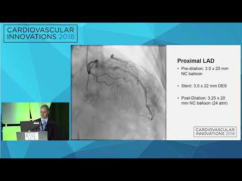 CVI2018 Session: Complex Multivessel PCI Prior to TAVR using a Transradial Approach