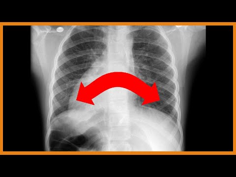 Primary Ciliary Dyskinesia (Kartagener Syndrome) vs. Cystic Fibrosis