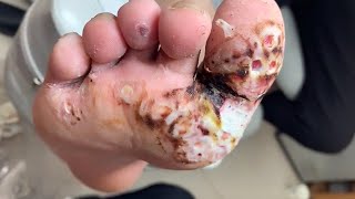 SCABS GROW NEW SKIN | REMOVE PLANTAR WARTS AFTER 5 TREATMENTS
