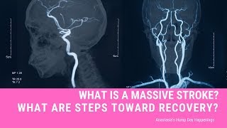 What Is A Massive Stroke?