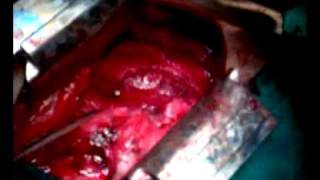preview picture of video 'Teratoma mediastinum surgery 2 _ 3gp'
