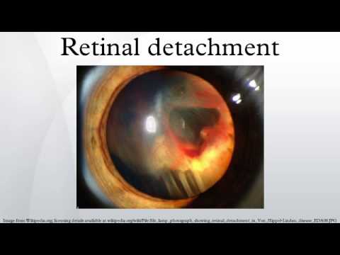 網膜剥離 (Retinal detachment)