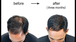 Home Remedies for Hair Growth - How to Grow Hair on Bald Head Home Remedies