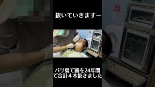 インドネシア,バリ島で23年間合計歯を4本抜きました。
