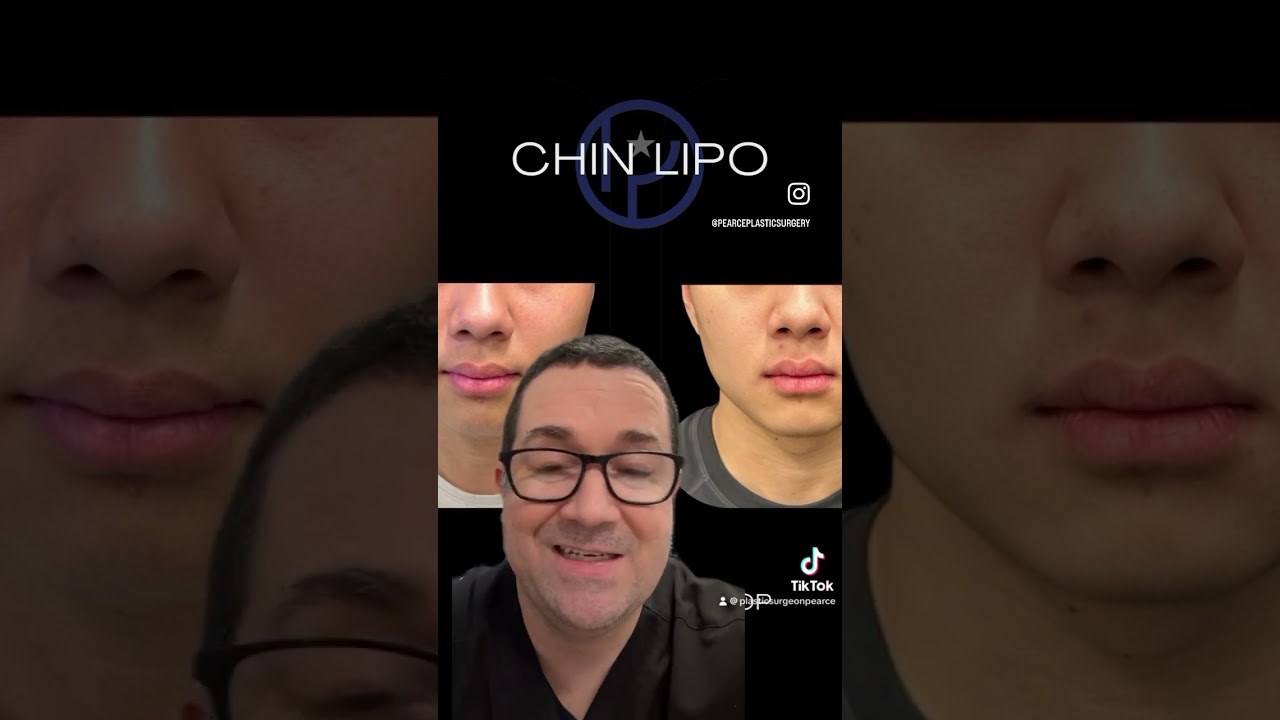 Male Chin Lipo || Austin Chin Lipo