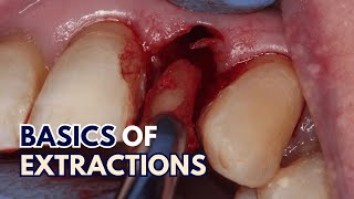 Exodontia for Beginners - Extraction Techniques - PS012