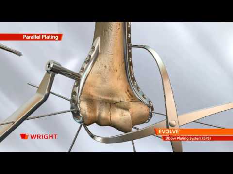 EVOLVE™ EPS Elbow Plating System