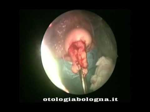 Medicina per vermi per risposte della gente Da una nausea lyambliya