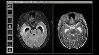 13-Radiation necrosis versus residual:recurrent tumoral activity