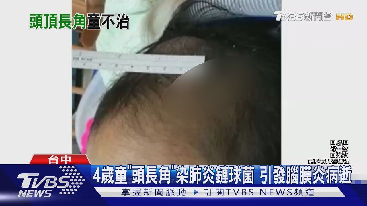 4歲童「頭長角」 染肺炎鏈球菌引發腦膜炎病逝