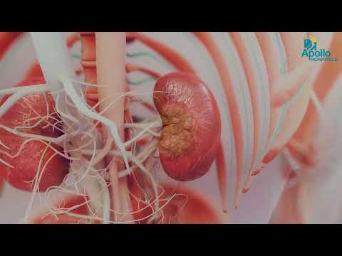 Antenatal to Postnatal Hydronephrosis Care | Dr. Balamourougane P | Apollo Hospitals