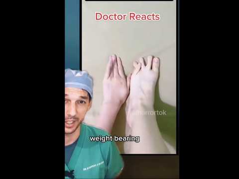 I have never seen a pinky toe move like that! #Foot #Pinky #toe #Fake #Real #Medical #Dr #Surgeon