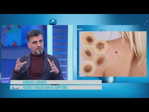 Hipokrati – Kanceri i lëkurës, shenjat që nuk duhet të neglizhojmë! Urgjent tek dermatologu