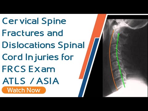 Cervical Spine Fractures and Dislocations | Spinal Cord Injuries for FRCS Exam | ATLS | ASIA