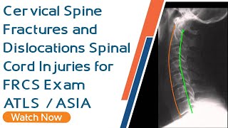 Cervical Spine Fractures and Dislocations | Spinal Cord Injuries for FRCS Exam | ATLS | ASIA
