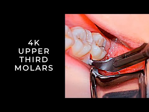 Third Molar Removal| Impacted Maxillary Third Molars | Erupted Lower