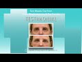 Dallas Fat Graft and Lower Blepharoplasty/ Eyelid Surgery Audio Testimonial with Photos