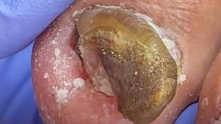 Trimming Onychomycosis Makes It Look Like A Small Stone!【Xue Yidao】