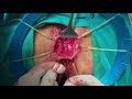 Martius Flap For Rectovaginal Fistula After Obstetric Injury A Video Vignette