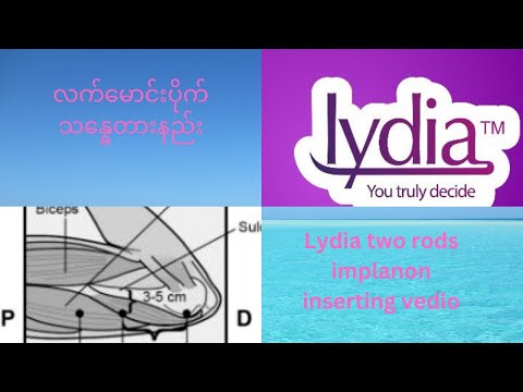 How to insert two rods implanon လက်မောင်းကိုယ်ဝန်တားပိုက် ထည့်သွင်းခြင်း (Laydia)
