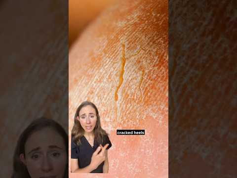 Get Rid Of Dry, Cracked Feet #dermatologist