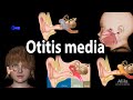Otitis Media: Anatomy, Pathophysiology, Risk Factors, Types of OM, Symptoms and Treatment, Animation