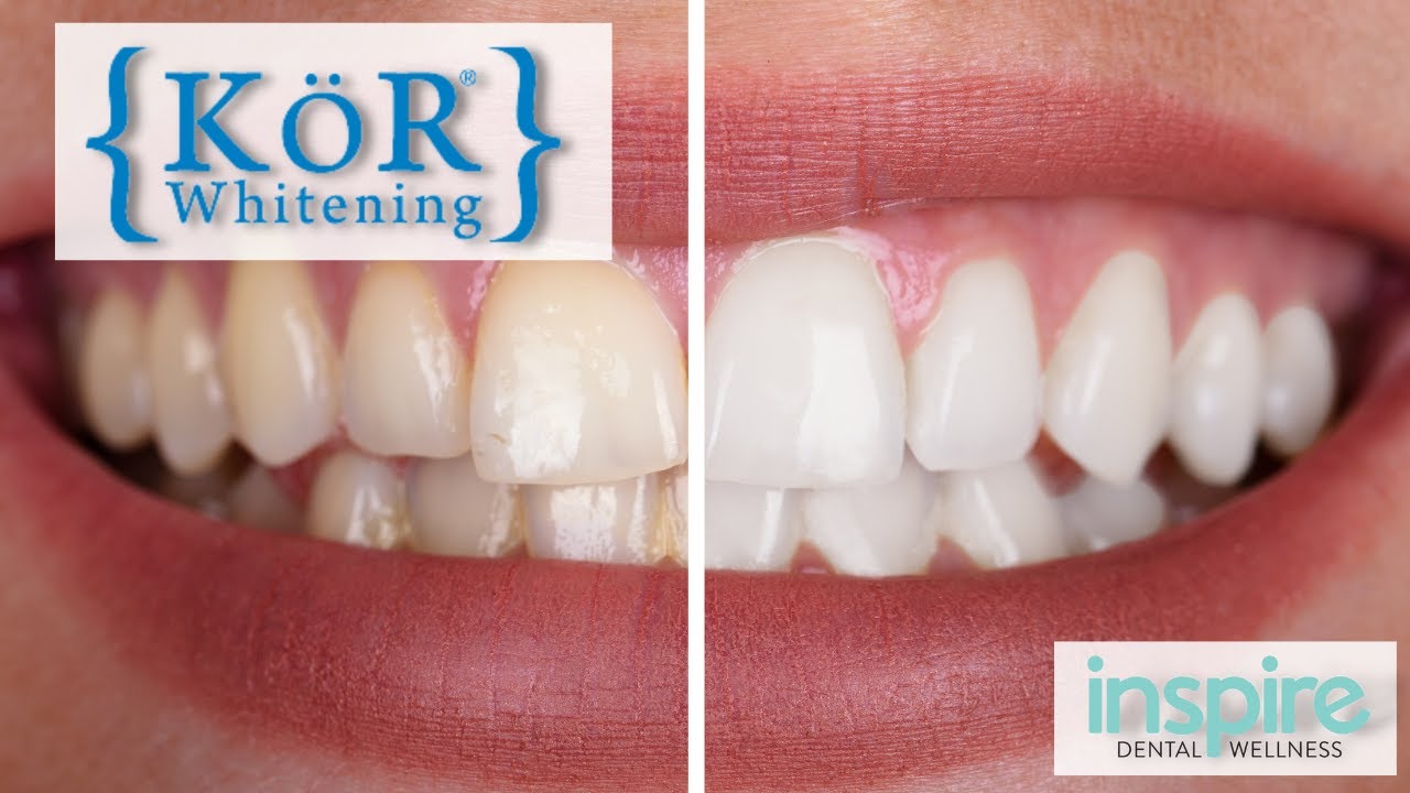 Danielle &mdash; KöR Whitening process walkthrough