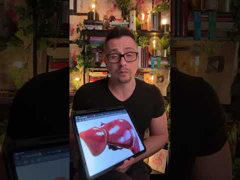 Рак кожи после загара на пляже!