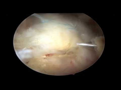 Ce se întâmplă artroza articulațiilor