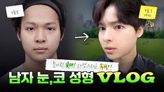 눈 코 수술 이렇게 하면 ‘옆태 미남’, 공개합니다!