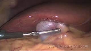 Gallbladder removal surgery