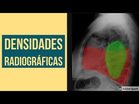 Como medir el indice cardiotoracico
