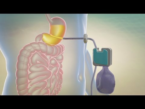 A new procedure allows you to eat without restriction and get rid of what you have eaten.