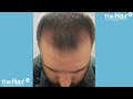 12 month FUE hair transplant journey