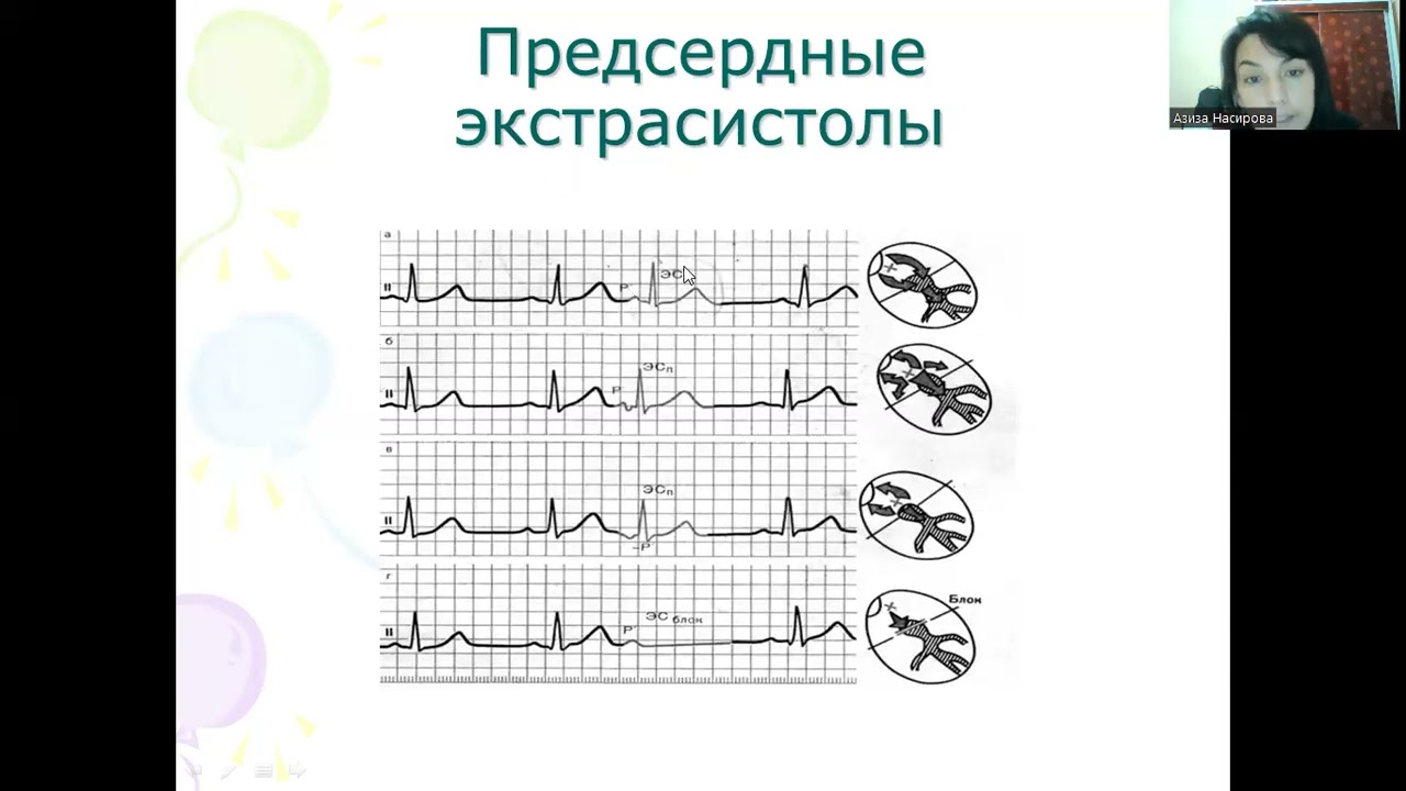 Электрокардиограмма при нарушениях ритма сердца